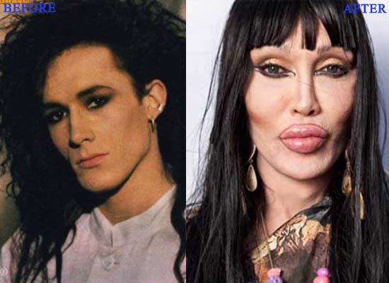 Pete-Burns-Plastic-Surgery1-Photo-Before-and-After
