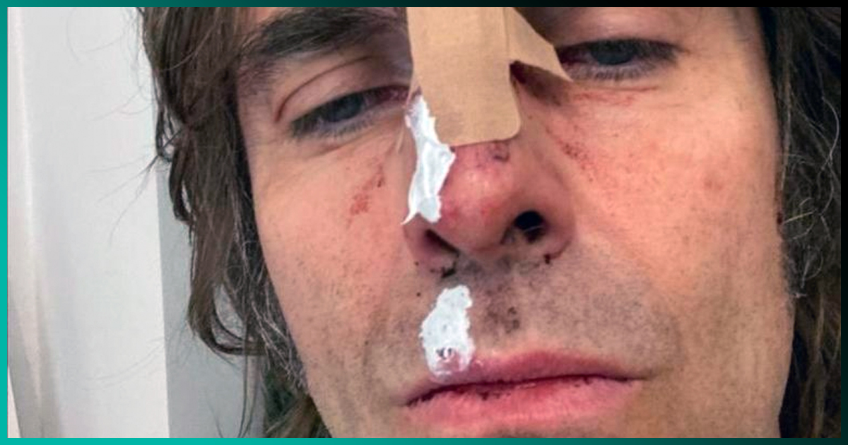 Liam Gallagher cayó de un helicóptero y muestra fotos de sus heridas