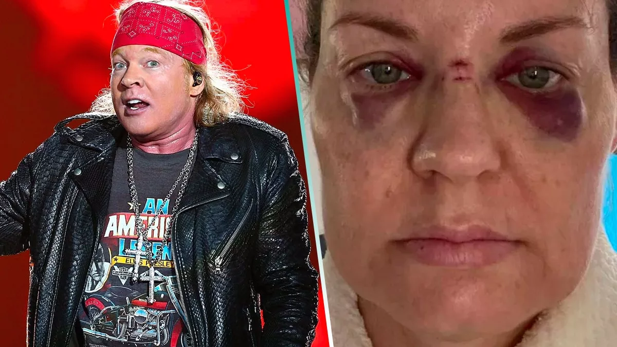 Axl Rose golpea a fan con su micrófono y la deja herida del rostro